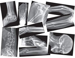 SPECIAL ORDER Broken Bones X-Ray Cards